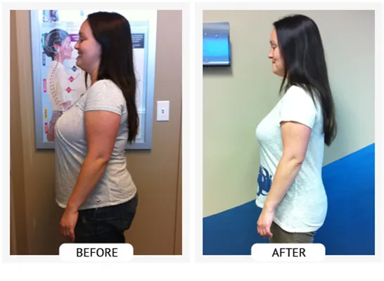 Chiropractic-renton-wa-angelica-before-after