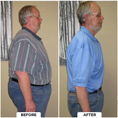 Chiropractic-renton-wa-blue-shirt-before-after