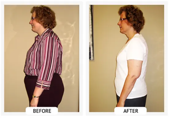 Chiropractic-renton-wa-sherry-before-after