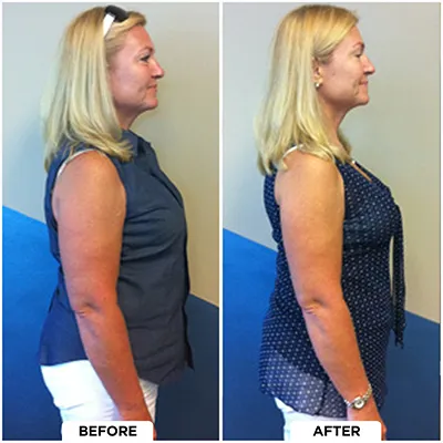 Chiropractic-renton-wa-woman-before-after